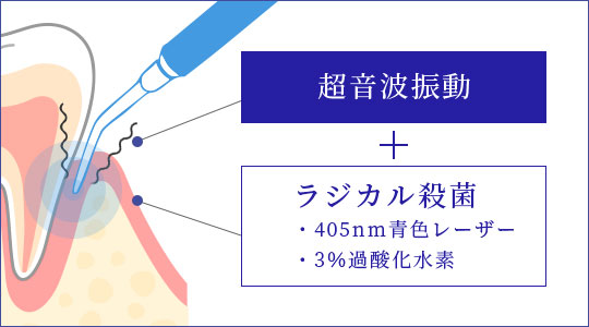 ブルーラジカルP-01による歯周治療